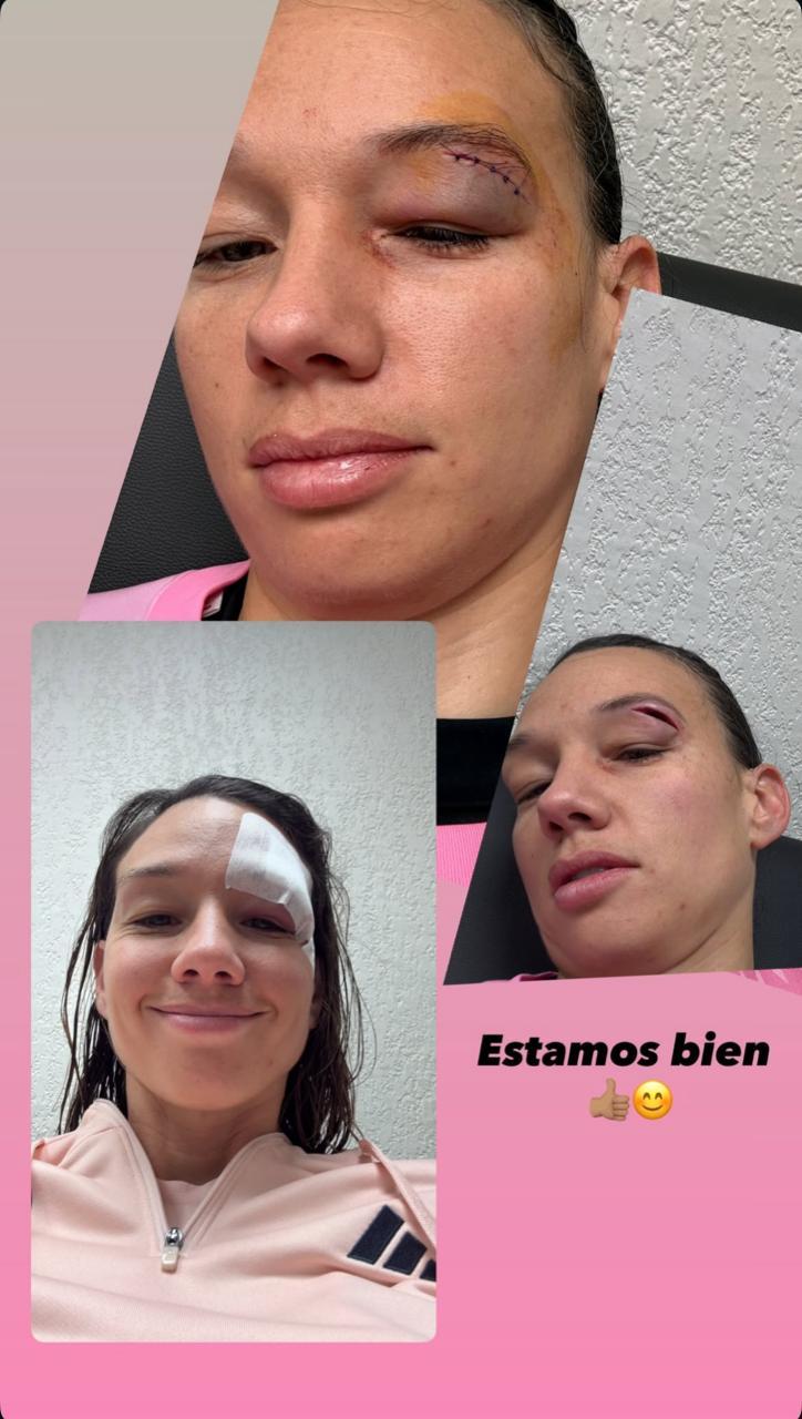 Christiane Endler tuvo que recibir puntos de sutura tras golpe en la cabeza - Redes Sociales