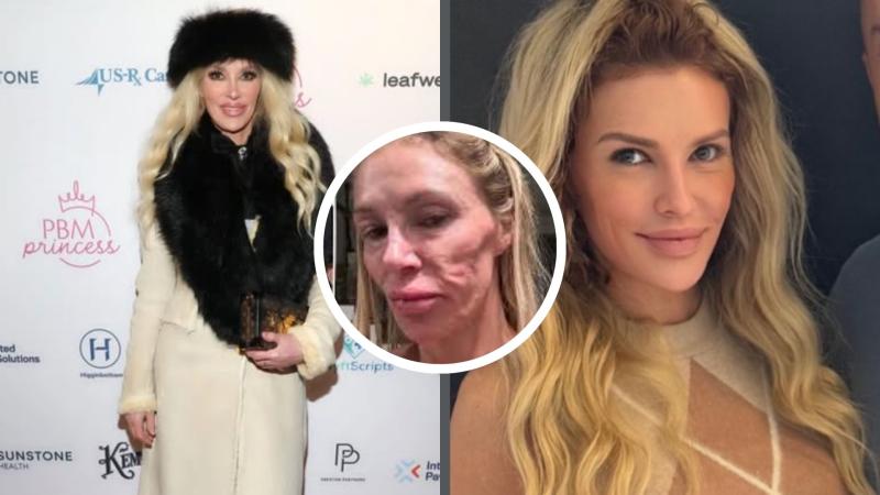 Instagram - Exmodelo estadounidense asegura que implantes mamarios rotos le provocaron "parásito" que le deformó el rostro