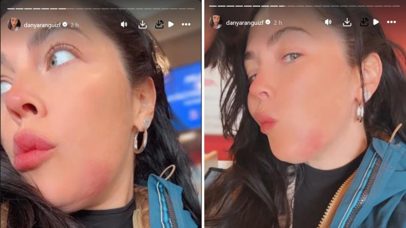 Captura de Instagram - Así quedó el rostro de Daniela Aránguiz