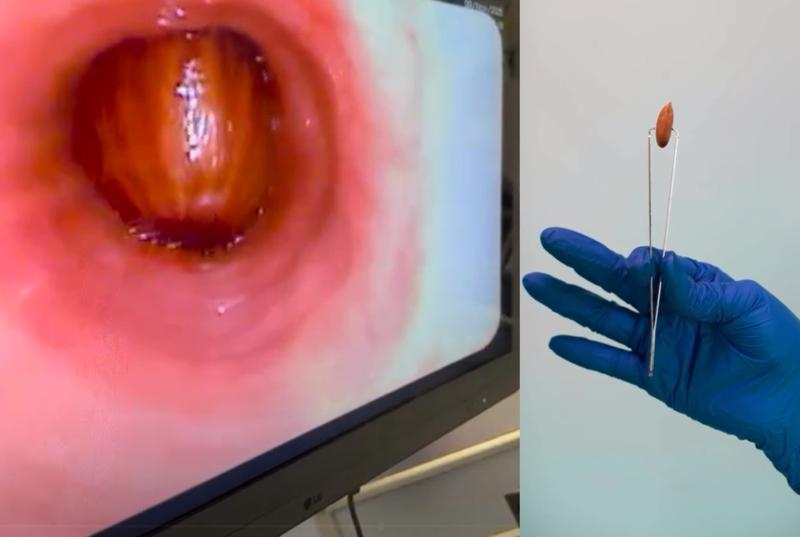 Mujer sufrió colapso pulmonar tras comer un chocolate con almendras: terminó en la UCI - captura Instagram Posta Central