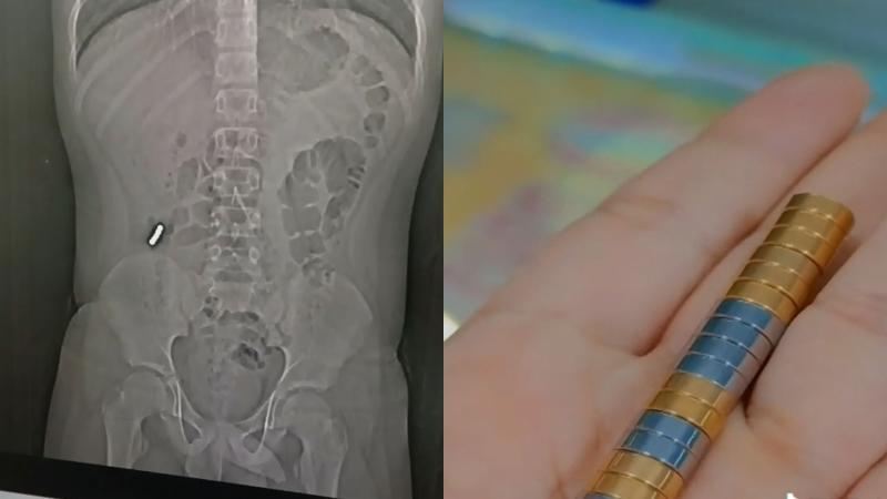 LTN - Siete menores operados en Chile por reto viral: uno tiene nueve perforaciones y otro ingirió 11 imanes