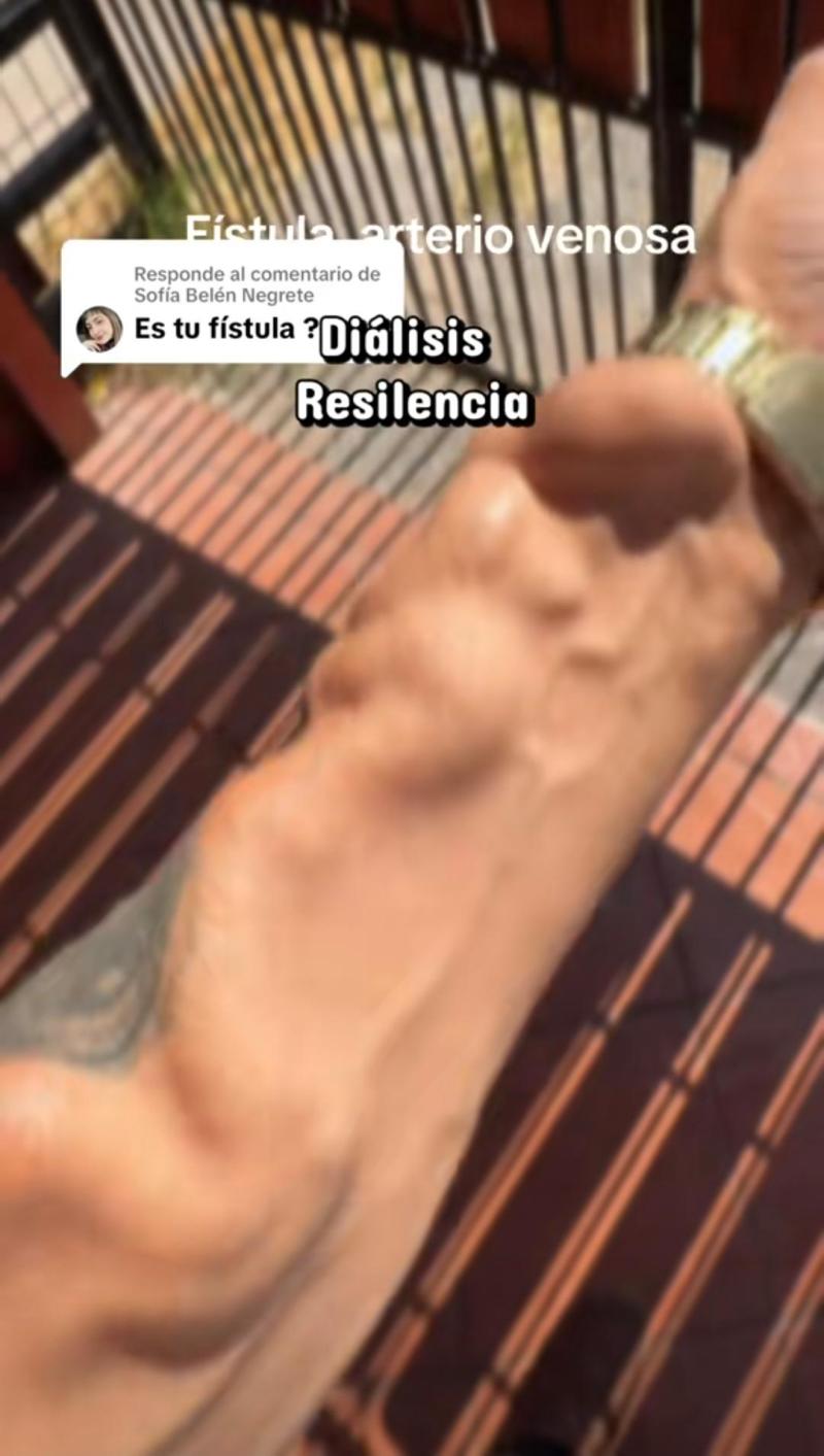 Fístula arteriovenosa en el brazo - TikTok @Darielsan2