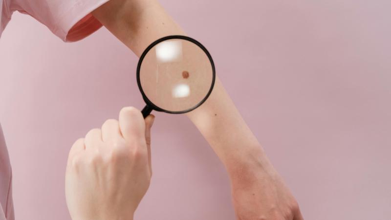 Pexels - Cáncer de piel (referencial)