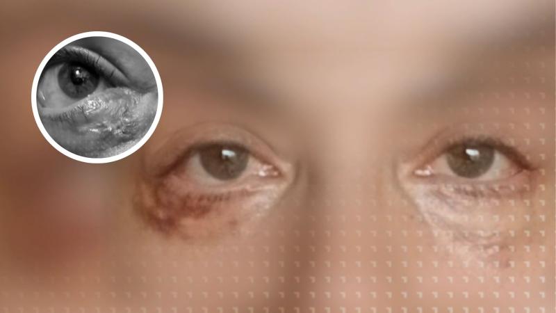 T13 - Chilena denuncia secuelas tras cirugía estética de ojeras y presenta querella contra médico