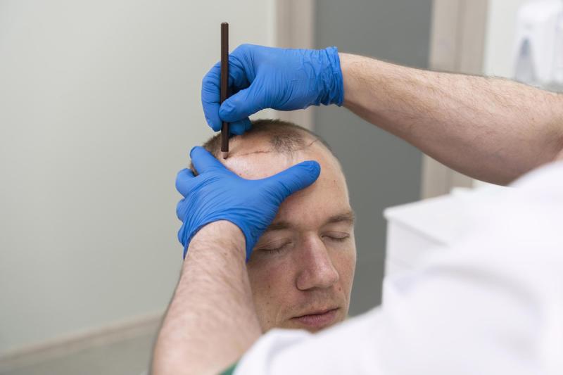 Magnific (referencial) - Implante capilar, la segunda cirugía estética realizada en los últimos años