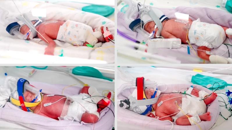 Metro North Health - El insólito caso de cuatrillizas nacidas en Australia: Son idénticas, por concepción natural y compartieron la misma placenta