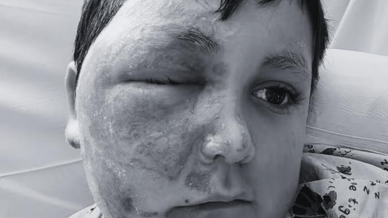 Alerta en EE.UU. por juguete que provoca quemaduras - Loyola Medicine