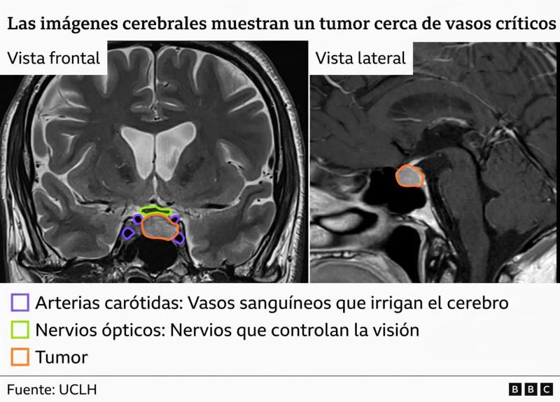 Identificó estructuras críticas: Realizan la primera operación cerebral asistida con IA - UCLH