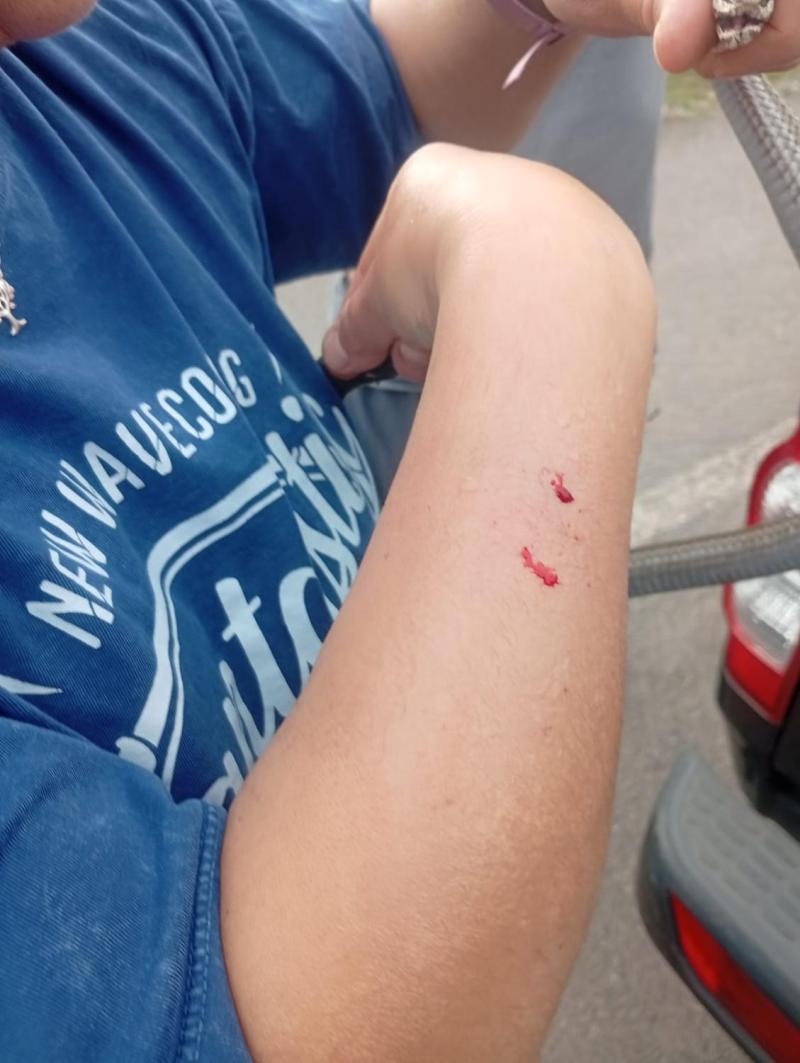 Facebook - Mujer sufre mordedura de culebra chilena