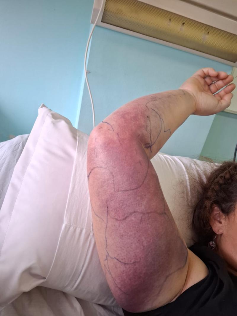 Facebook - Mujer sufre mordedura de culebra chilena