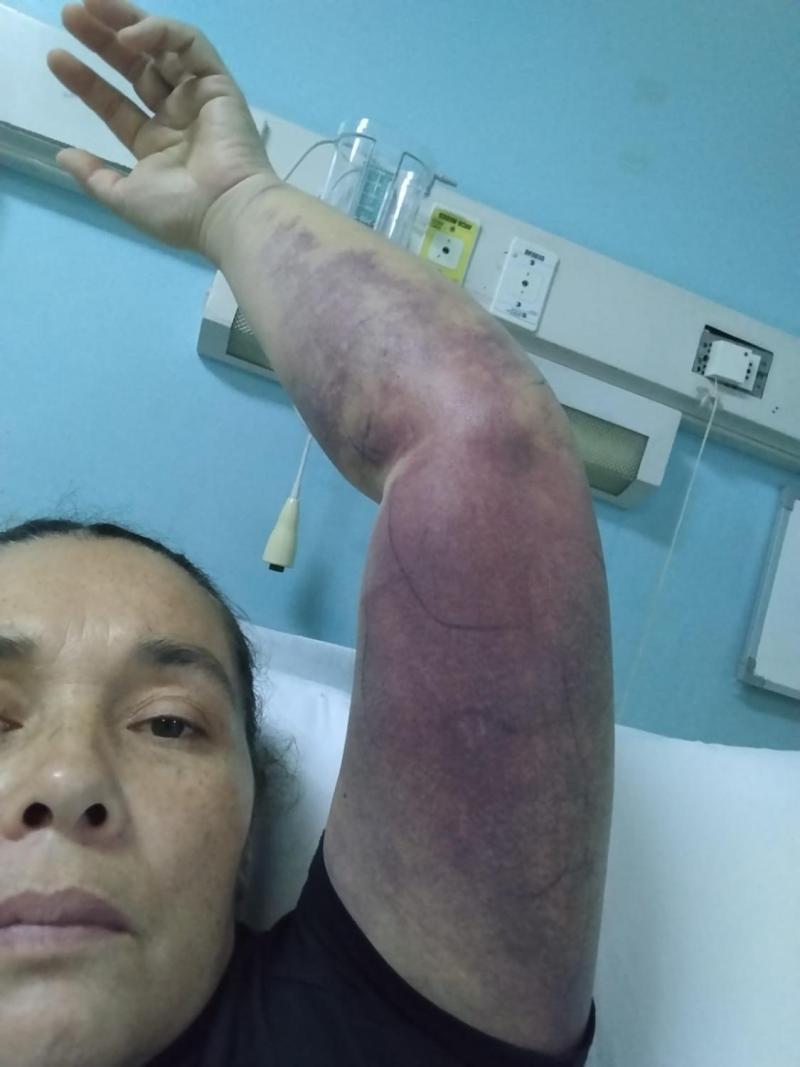 Facebook - Mujer sufre mordedura de culebra chilena