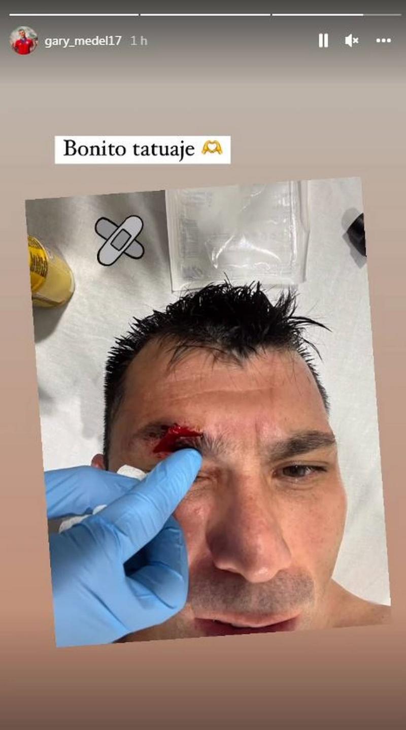 Gary Medel terminó con un corte tras chocar con Zlatan.