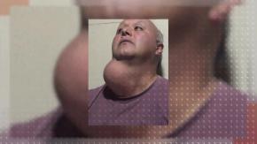 Le cuesta dormir y se ahoga por las noches: Hombre sigue en lista de espera en el Hospital de Temuco pese a tumor