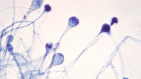 "Un desafío mayor que el coronavirus": India reporta cerca de 9 mil casos de mucormicosis "Un desafío mayor que el coronavirus": India reporta cerca de 9 mil casos de mucormicosis