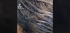 [VIDEO] Revelan impactante caso de niña con más de 15 mil piojos en su cabeza