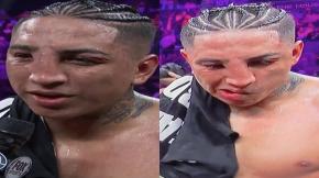 Rostro de boxeador desfigurado tras una pelea impacta en redes sociales Rostro de boxeador desfigurado tras una pelea impacta en redes sociales