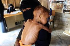 El terrible caso de Randa: La niña de Yemen que a los 3 años solo pesa 4 kilos El terrible caso de Randa: La niña de Yemen que a los 3 años solo pesa 4 kilos