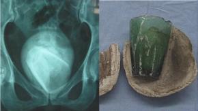 Mujer fue al médico por supuesta infección urinaria: Tenía un vaso de vidrio en su vejiga hace años