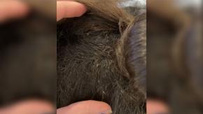 "Encima de su oreja estaba llena de huevos": Niña llevaba 6 meses con piojos hasta en el cuello "Encima de su oreja estaba llena de huevos": Niña llevaba 6 meses con piojos hasta en el cuello