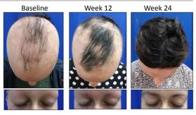 Pastilla contra la alopecia podría recuperar el 80% del cabello caído en seis meses Pastilla contra la alopecia podría recuperar el 80% del cabello caído en seis meses