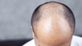 Aprueban primera píldora para el tratamiento de la alopecia en Estados Unidos Aprueban primera píldora para el tratamiento de la alopecia en Estados Unidos