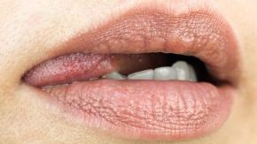 Las enfermedades que pueden transmitirse durante el sexo oral sin preservativo y cómo protegerte Las enfermedades que pueden transmitirse durante el sexo oral sin preservativo y cómo protegerte