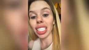 Mujer se puso carillas dentales y viralizó el resultado: “Parezco un maldito caballo” Mujer se puso carillas dentales y viralizó el resultado: “Parezco un maldito caballo”
