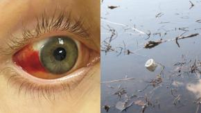 Joven se contagió con peligrosa enfermedad tras caer en canal con orina de rata Joven se contagió con peligrosa enfermedad tras caer en canal con orina de rata