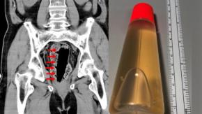 Extraen tubo de pegamento del cuerpo de un hombre: Lo usaba como remedio para la constipación Extraen tubo de pegamento del cuerpo de un hombre: Lo usaba como remedio para la constipación