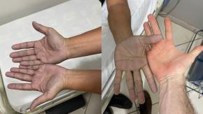 Hombre fue al médico porque tenía las "manos azules" y recibió insólito diagnóstico Hombre fue al médico porque tenía las "manos azules" y recibió insólito diagnóstico