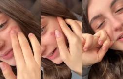 "Cicatriz francesa": el reto de autolesión que tiene a Tiktok bajo investigación en Italia "Cicatriz francesa": el reto de autolesión que tiene a Tiktok bajo investigación en Italia