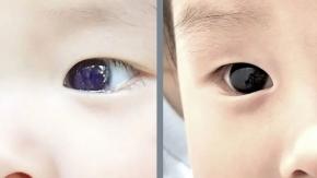 Bebé cambia color de ojos tras tratamiento contra el Covid
