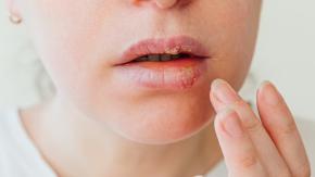 El virus del herpes simple duplicaría el riesgo de padecer Alzheimer El virus del herpes simple duplicaría el riesgo de padecer Alzheimer