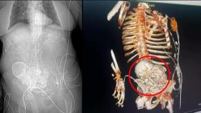 Mujer muere tras tener un feto calcificado durante 30 años en su cuerpo Mujer muere tras tener un feto calcificado durante 30 años en su cuerpo