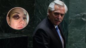 Alberto Fernández dijo a medio argentino que no golpeaba a su expareja: Asegura que moretones se deberían a procedimiento antiarrugas Alberto Fernández dijo a medio argentino que no golpeaba a su expareja: Asegura que moretones se deberían a procedimiento antiarrugas
