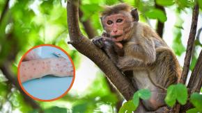 Emergencia sanitaria por viruela del mono: Muertes en el Congo superan las 500 este año Emergencia sanitaria por viruela del mono: Muertes en el Congo superan las 500 este año