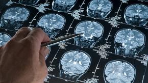 Vida y Salud: ¿Cómo prevenir un accidente cerebro vascular?