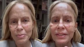 "He quedado con varias lesiones": Cecilia Bolocco se baja de la Teletón por problema médico relacionado a su piel "He quedado con varias lesiones": Cecilia Bolocco se baja de la Teletón por problema médico relacionado a su piel