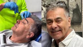 Pato Torres se hizo procedimiento estético en su rostro y mostró los resultados: actor se inyectó bótox Pato Torres se hizo procedimiento estético en su rostro y mostró los resultados: actor se inyectó bótox