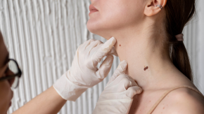 Cáncer a la piel: ¿Cómo saber si mis lunares son peligrosos?