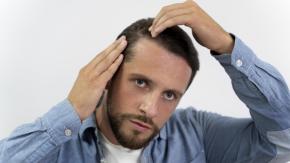 ¿A qué edad comienza la calvicie masculina y de qué factores depende? Esto dice la ciencia”