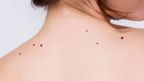 Puntos rubí: Qué son, por qué aparecen y qué hacer con estos "lunares rojos" en la piel Puntos rubí: Qué son, por qué aparecen y qué hacer con estos "lunares rojos" en la piel
