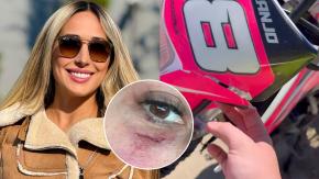 Pareja de Nano Calderón sufrió accidente en moto: mostró en redes las graves heridas en su rostro Pareja de Nano Calderón sufrió accidente en moto: mostró en redes las graves heridas en su rostro