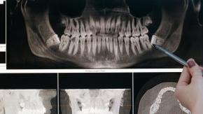 ¿La caries avanza o se detiene? Cómo evitar que despierten las lesiones inactivas