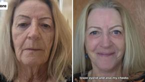 Mujer de 73 años mostró los resultados de impactante cirugía estética que se realizó: “Parece 20 años más joven”