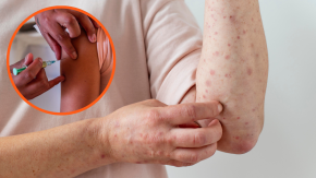 Alerta epidemiológica: Qué es el sarampión, cuáles son sus síntomas y quiénes pueden contagiarse Alerta epidemiológica: Qué es el sarampión, cuáles son sus síntomas y quiénes pueden contagiarse