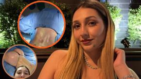 Qué es la lipotransferencia, la operación que se hizo la influencer Carlita y que generó su impactante cambio físico