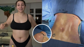 Cuánto costó la cirugía estética de la influencer 'Carlita' Inostroza que impactó en redes sociales