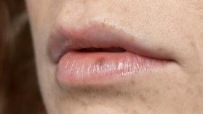 Cáncer labial: Cómo prevenirlo, señales de alerta y lo que no se debería pasar por alto