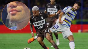 "Cómo lo van a molestar": Las duras críticas a jugador de Boca que se habría hecho retoque estético en su rostro